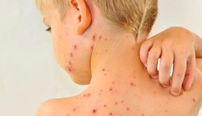 الحصبة تهدّد الولايات المتحدة بعد اكتشاف أكثر من 400 إصابة